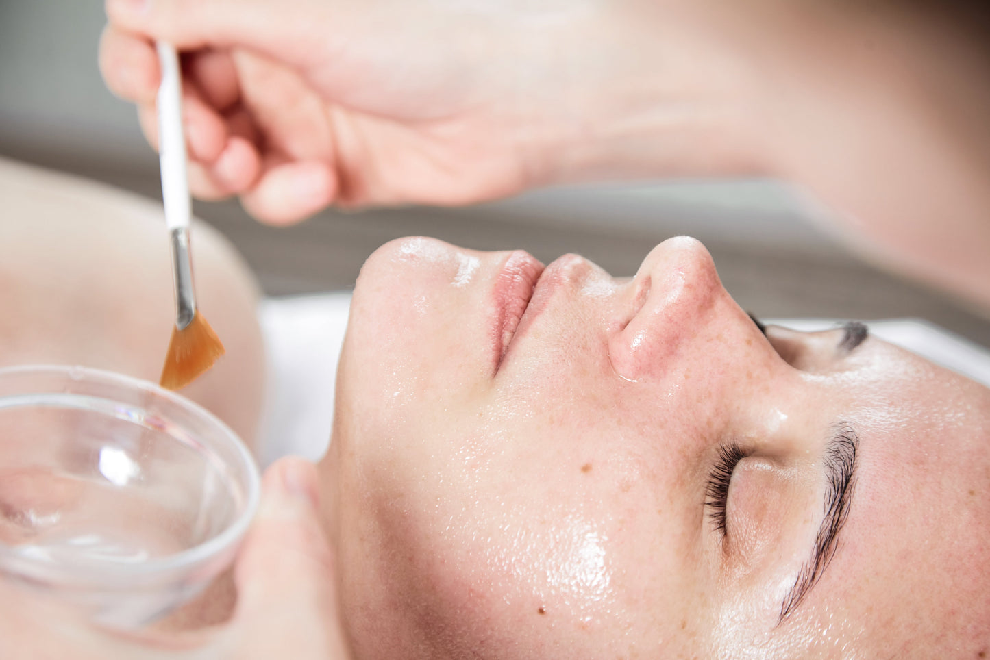 30% Glycolic Acid Peel